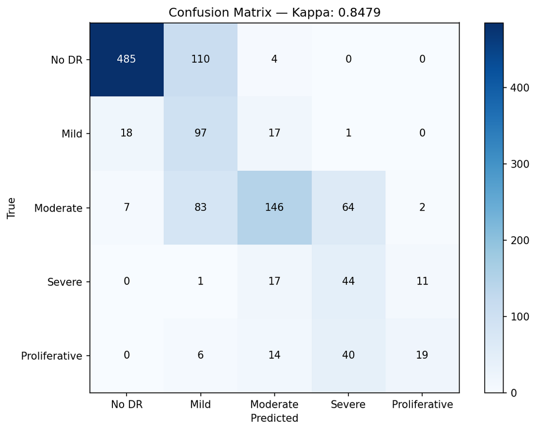 5x5 verwarringsmatrix: AI-graad vs. expertgraad op APTOS hold-out set